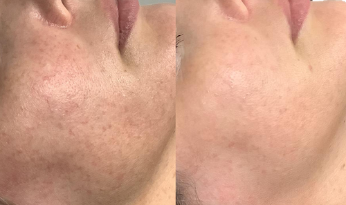 hyperpigmentation treatment before after mississauga oakville